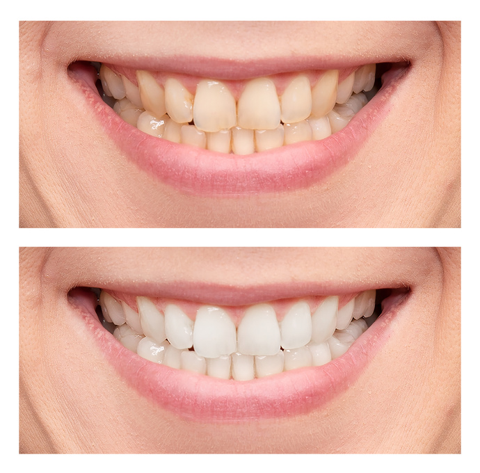 Teeth Whitening. Close up of Female Mouth.
